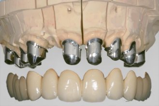 Zahnersatz mit Teleskopen, Primärteile auf dem Modell, Prothese zum darüber schieben.