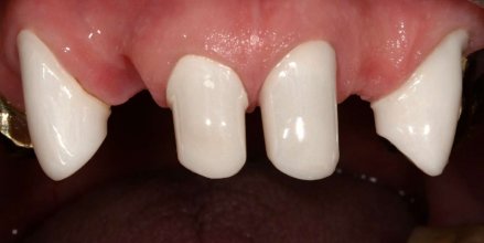 Primärteile aus Zirkonkeramik